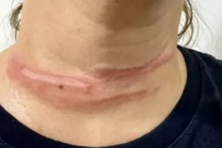 Motociclista fica ferida após ser atingida por fio solto em via pública de Livramento de Nossa Senhora